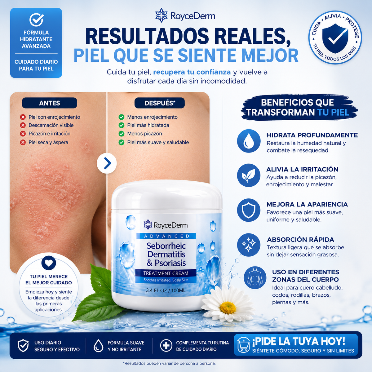RoyceDerm Crema para Dermatitis Seborreica y Psoriasis