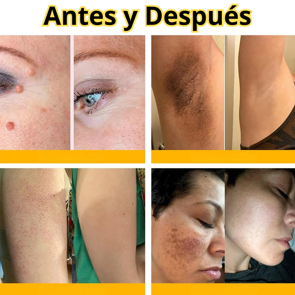 Crema Mágica para Verrugas